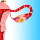 Почему развивается внематочная беременность Внематочная беременность справа